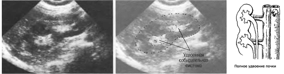 Удвоенная почка у взрослого фото
